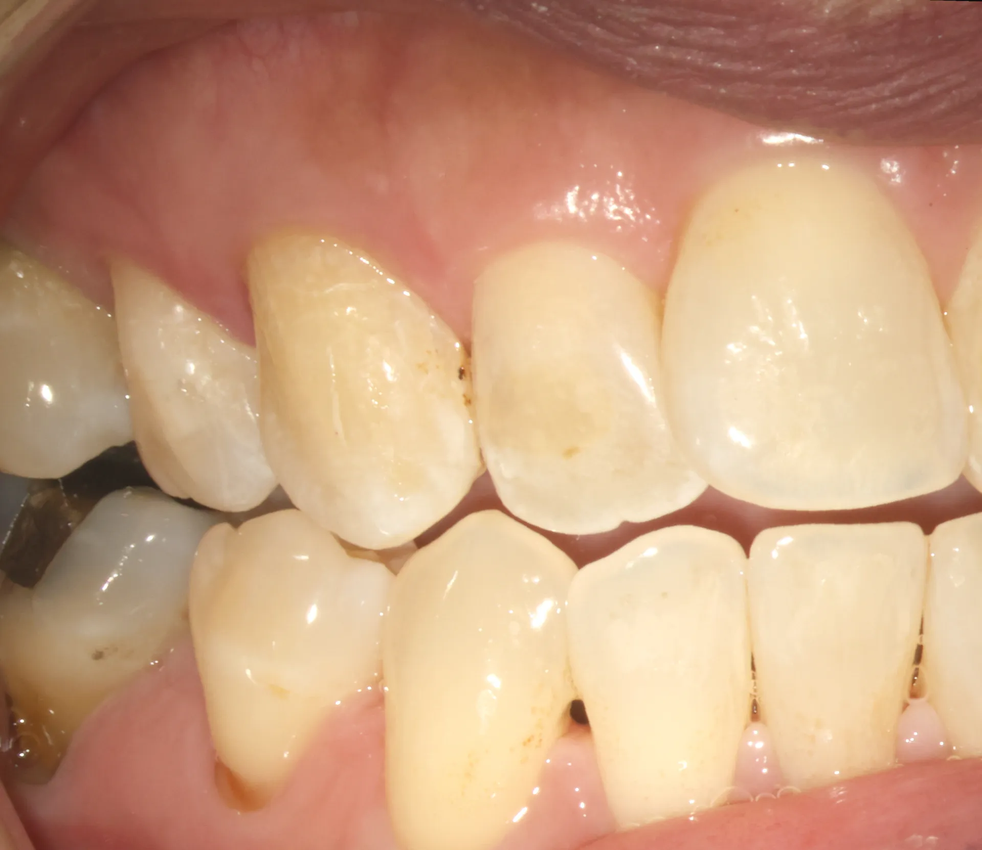 Buccal view after internal bleaching showing final aesthetic result with tooth blending naturally with adjacent teeth